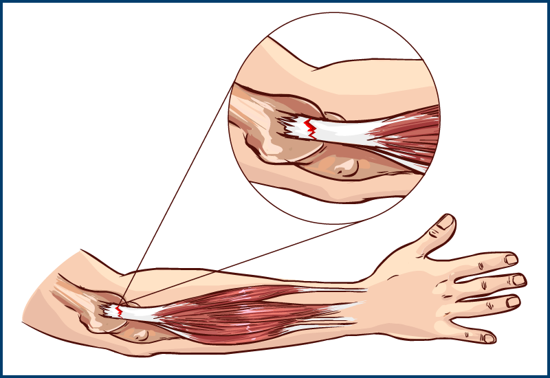 Golfers Elbow diagnosis and Chiropractic treatment